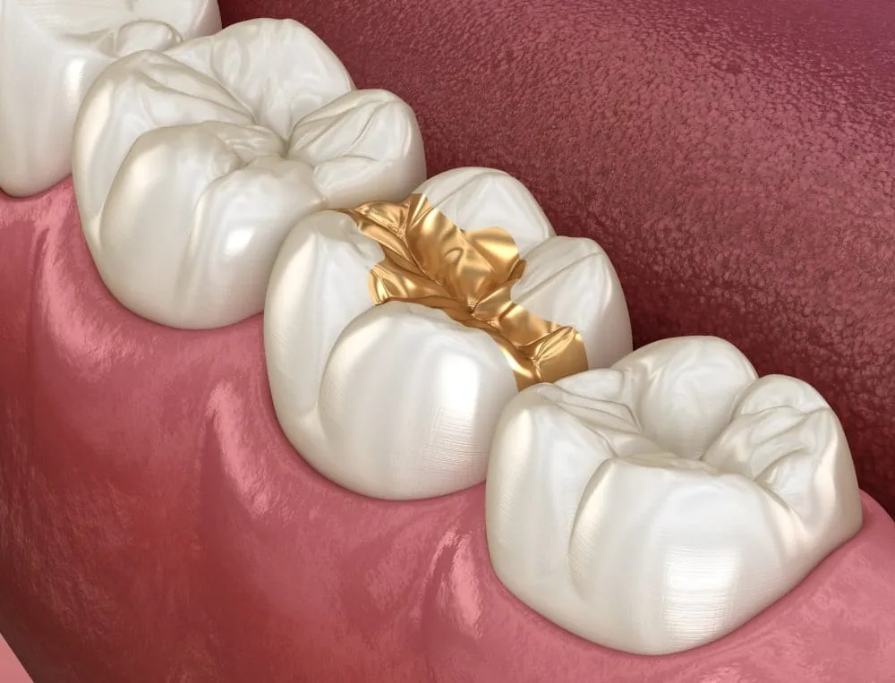 gold fillings