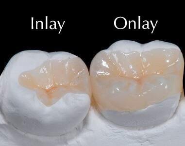 inlays and onlays