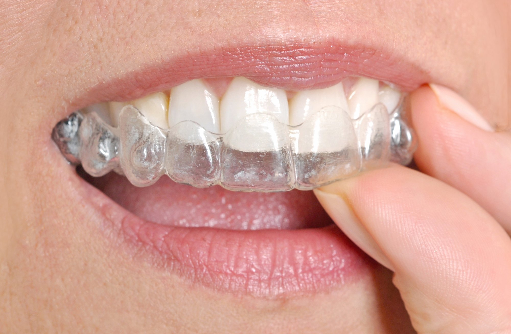 invisible-braces-G67LFVW