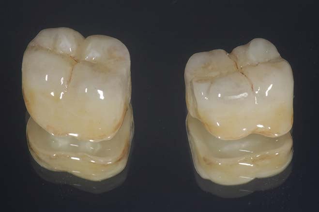 lithium-disilicate-crowns-smile-dental-care-oral-health