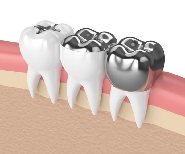 metal dental crown