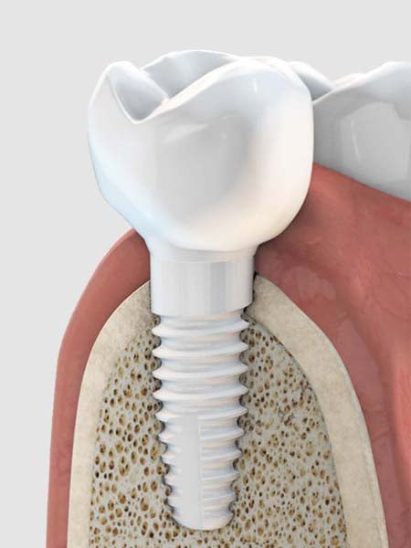 metal-free-dental-implants-dental-care-oral-health