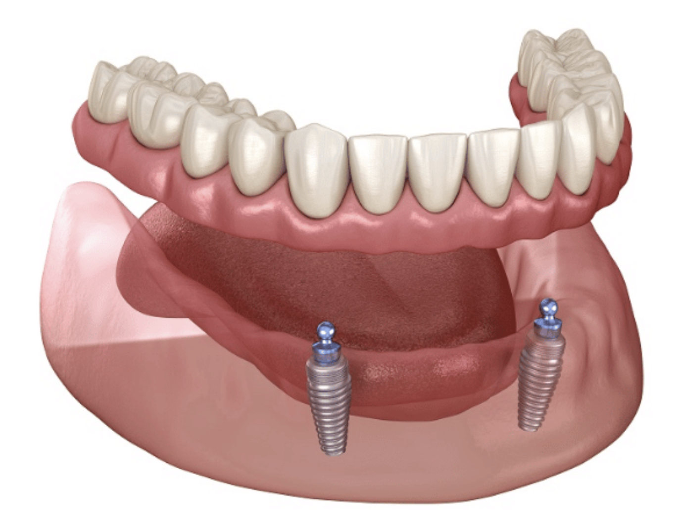 mini implants