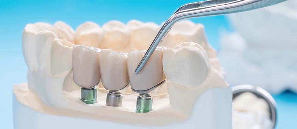 multiple-dental-implants-dental-care-oral-health