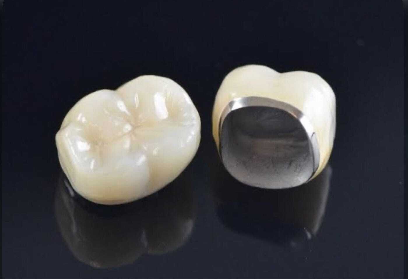 pfm dental crown
