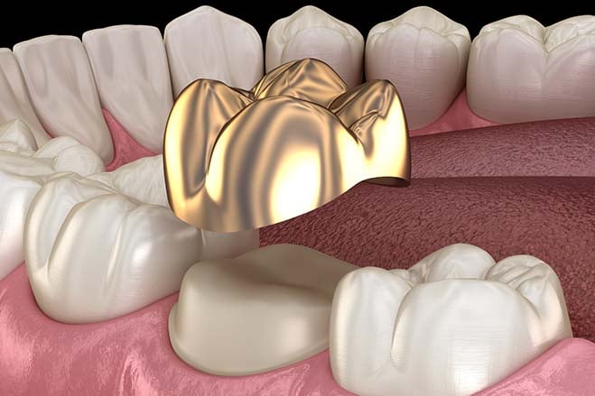 precious-metal-crowns-gold-smile-dental-care-oral-health