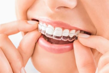 Webinar: 10 Things You Need to Know About Invisalign