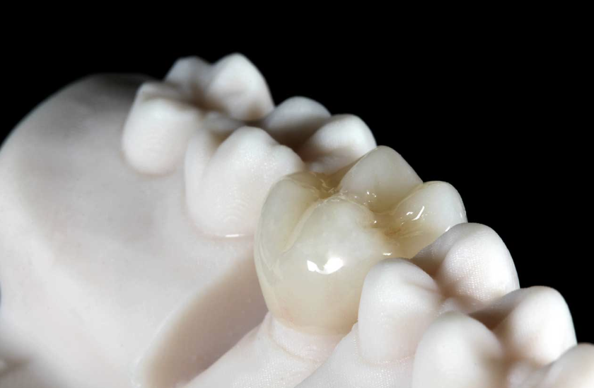 resin dental crown