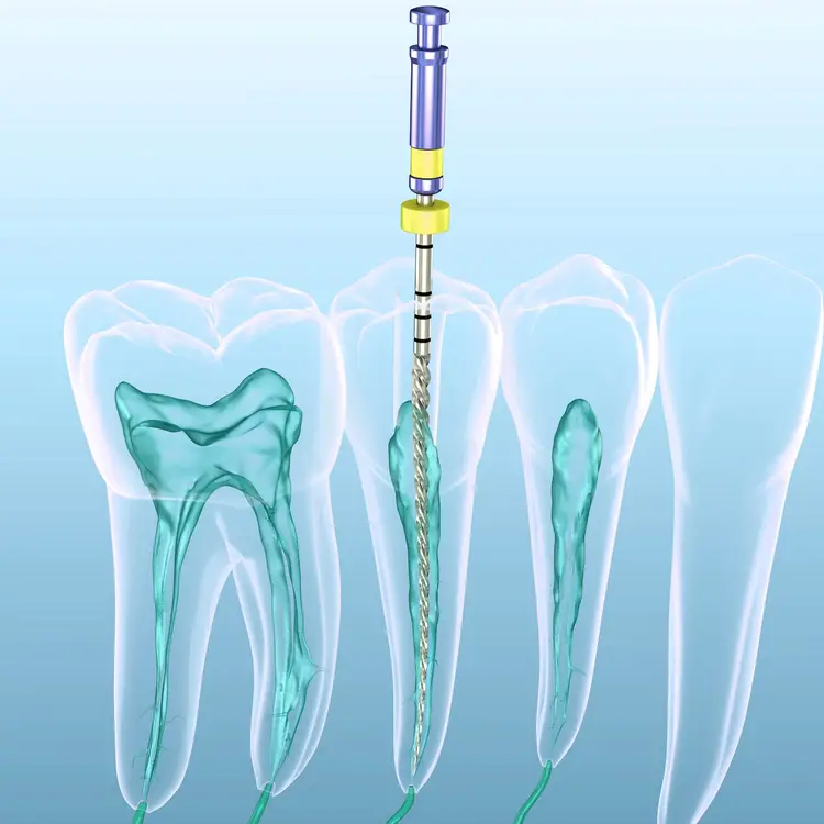 root-canal-treatment-concept-750