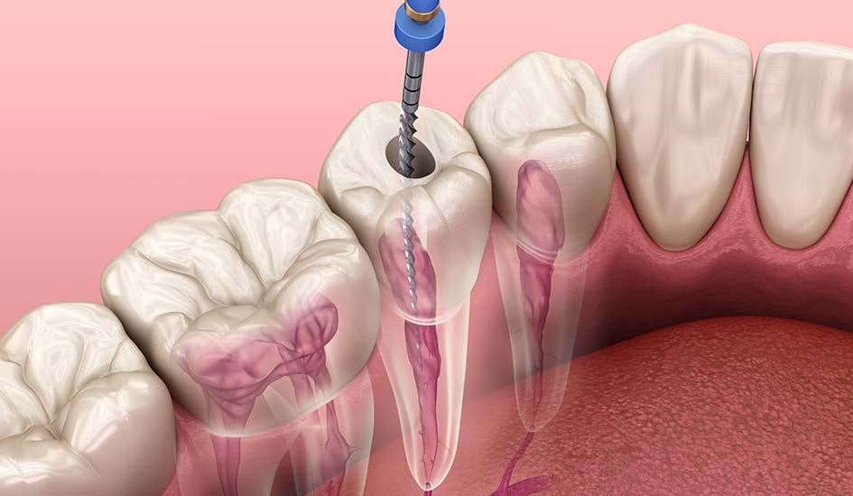 root-canal-treatment-dental-care-oral-health-1