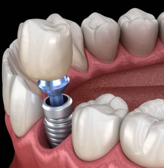 same day implants