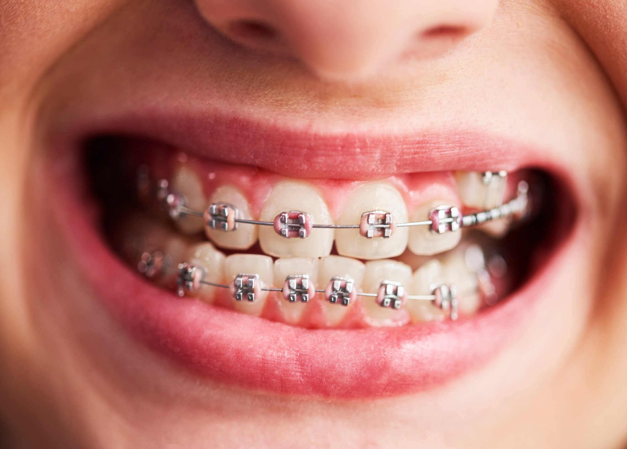 shot-of-childs-teeth-with-braces-8YXWJN3