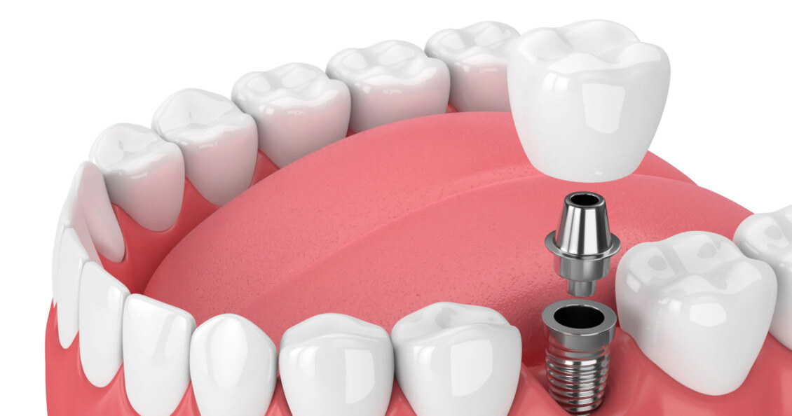single tooth implant
