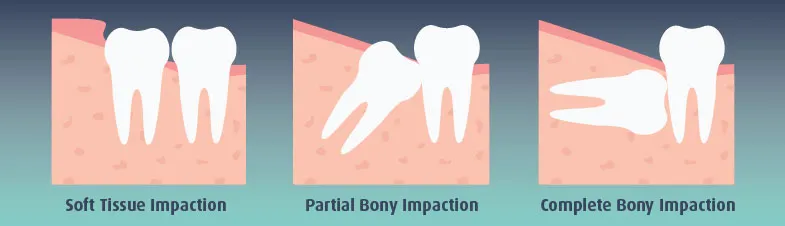 soft tissue impaction vs bony impaction