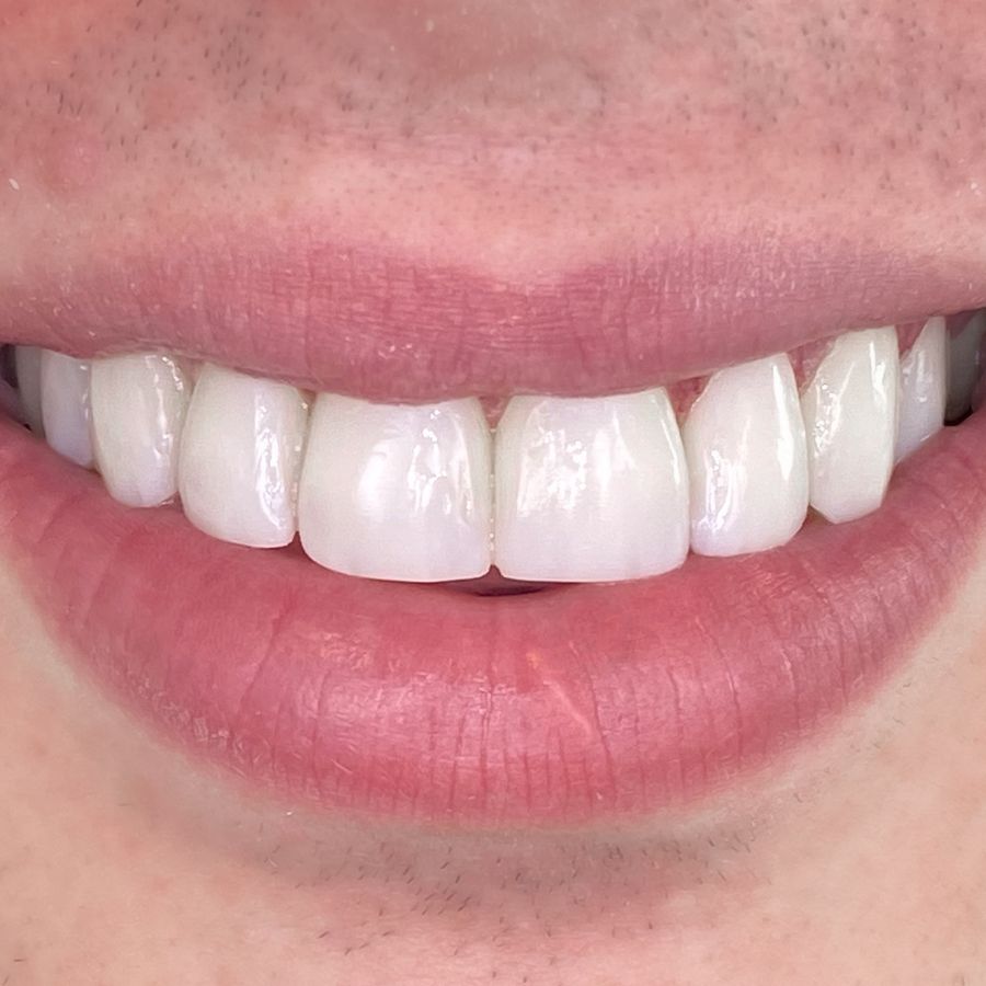 teeth bonding