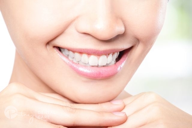 tooth reshaping