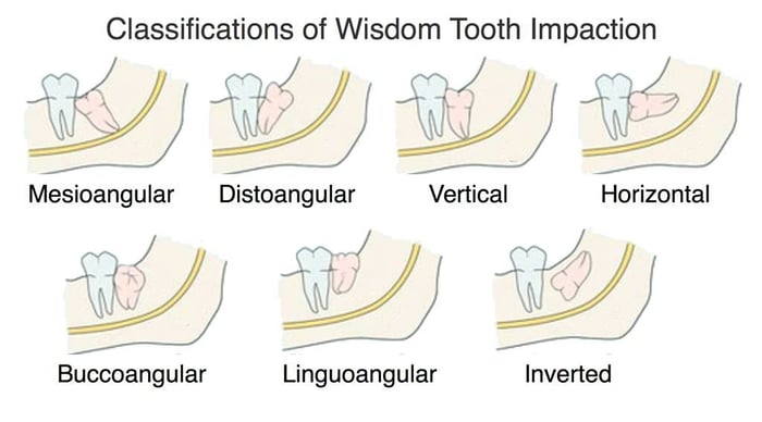 types of impacted wisdom teeth