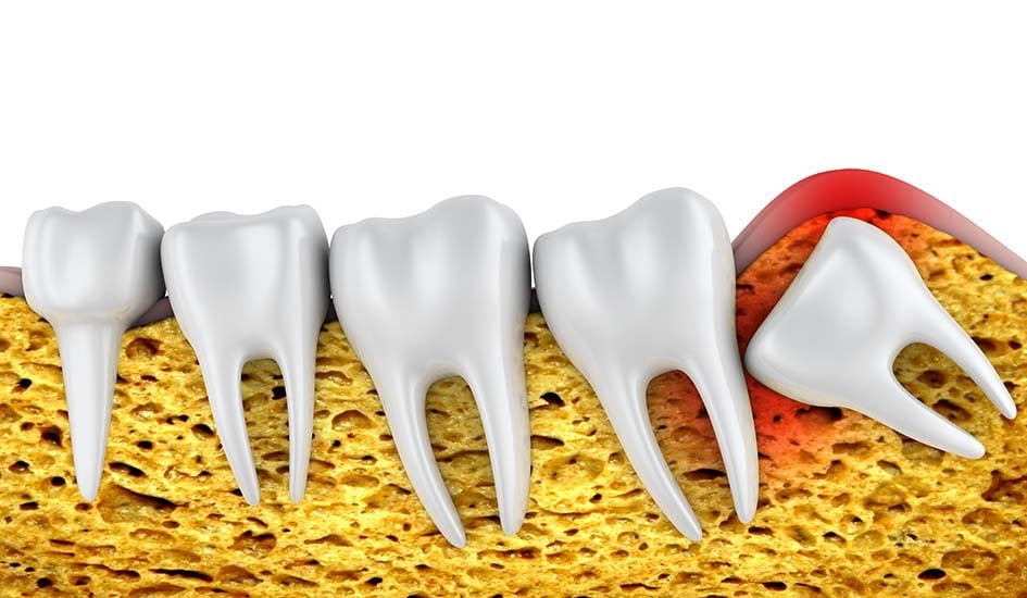 what-is-wisdom-tooth-surgery-dental-care-oral-health