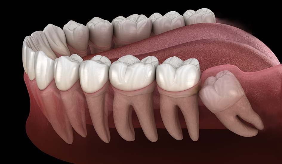 wisdom-tooth-surgery-dental-care-oral-health