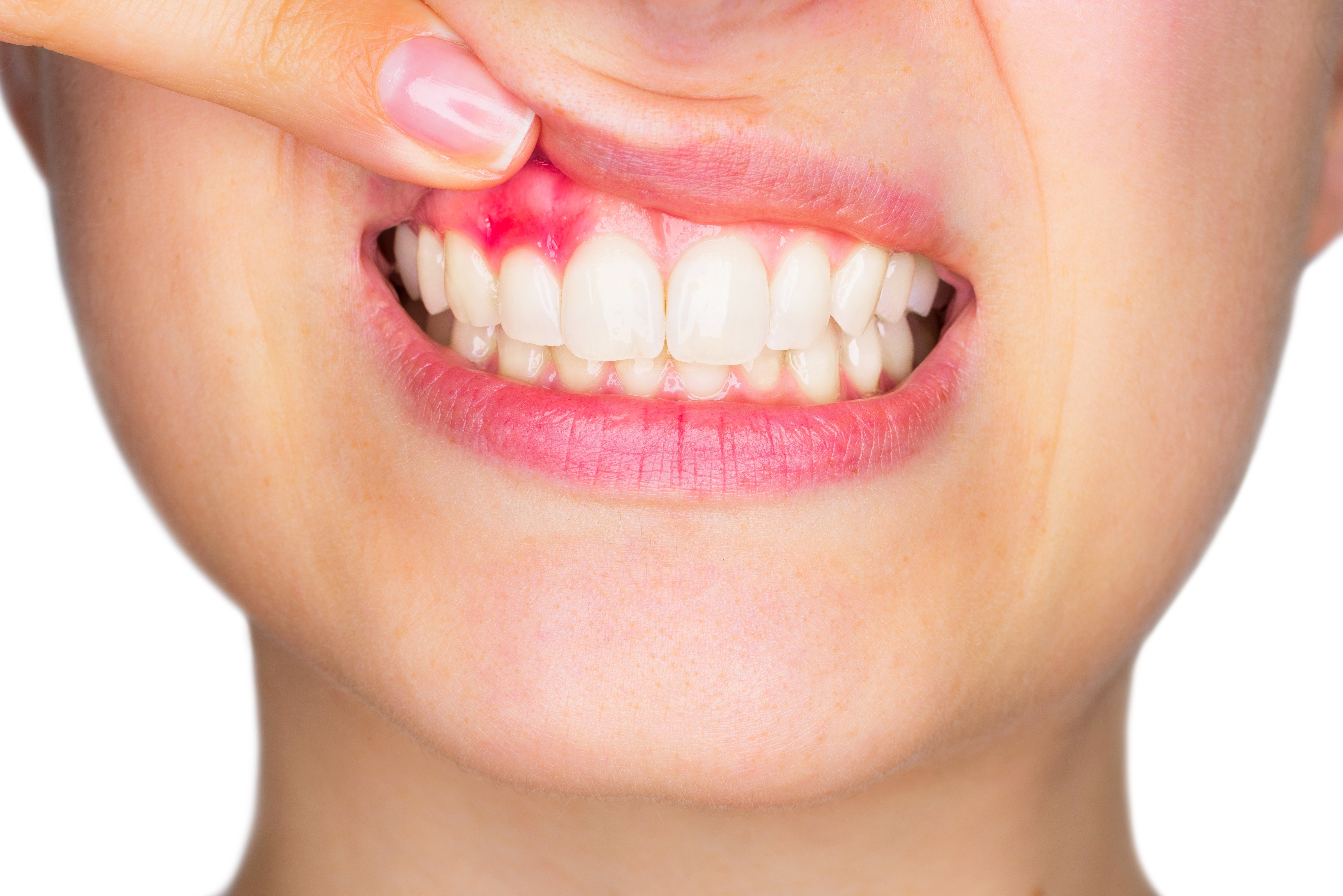 03 Bleeding gums2