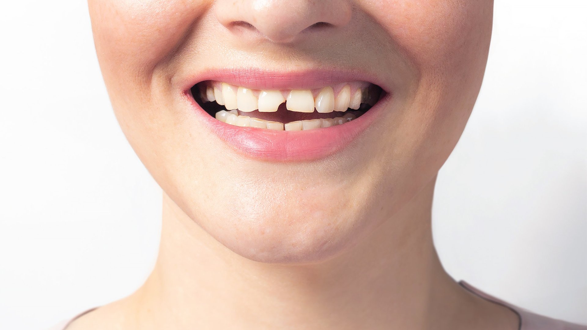 04 Chipped or broken teeth1