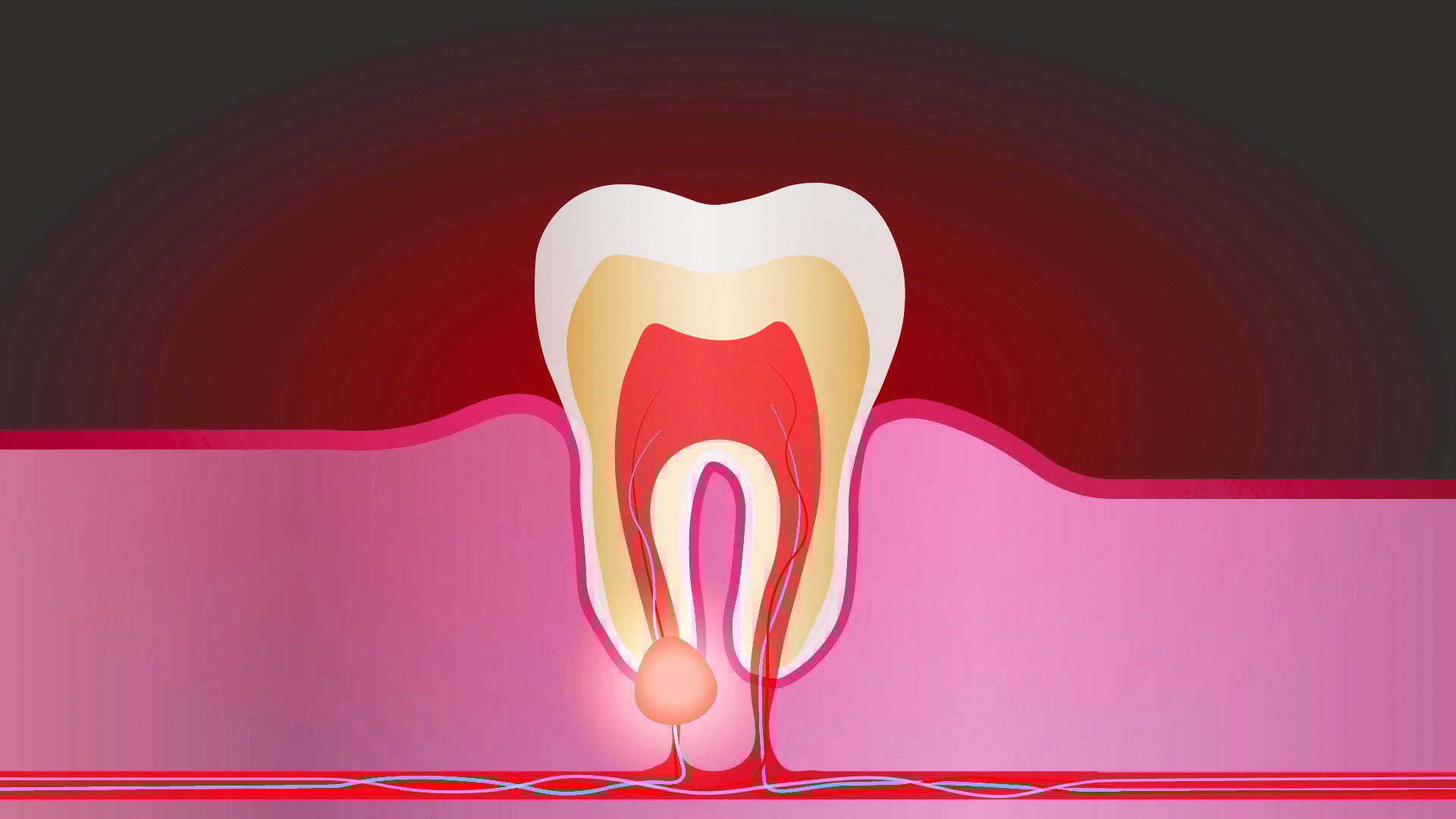 06 Abscessed tooth