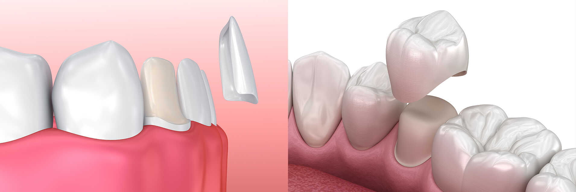 19_Veneers + crown