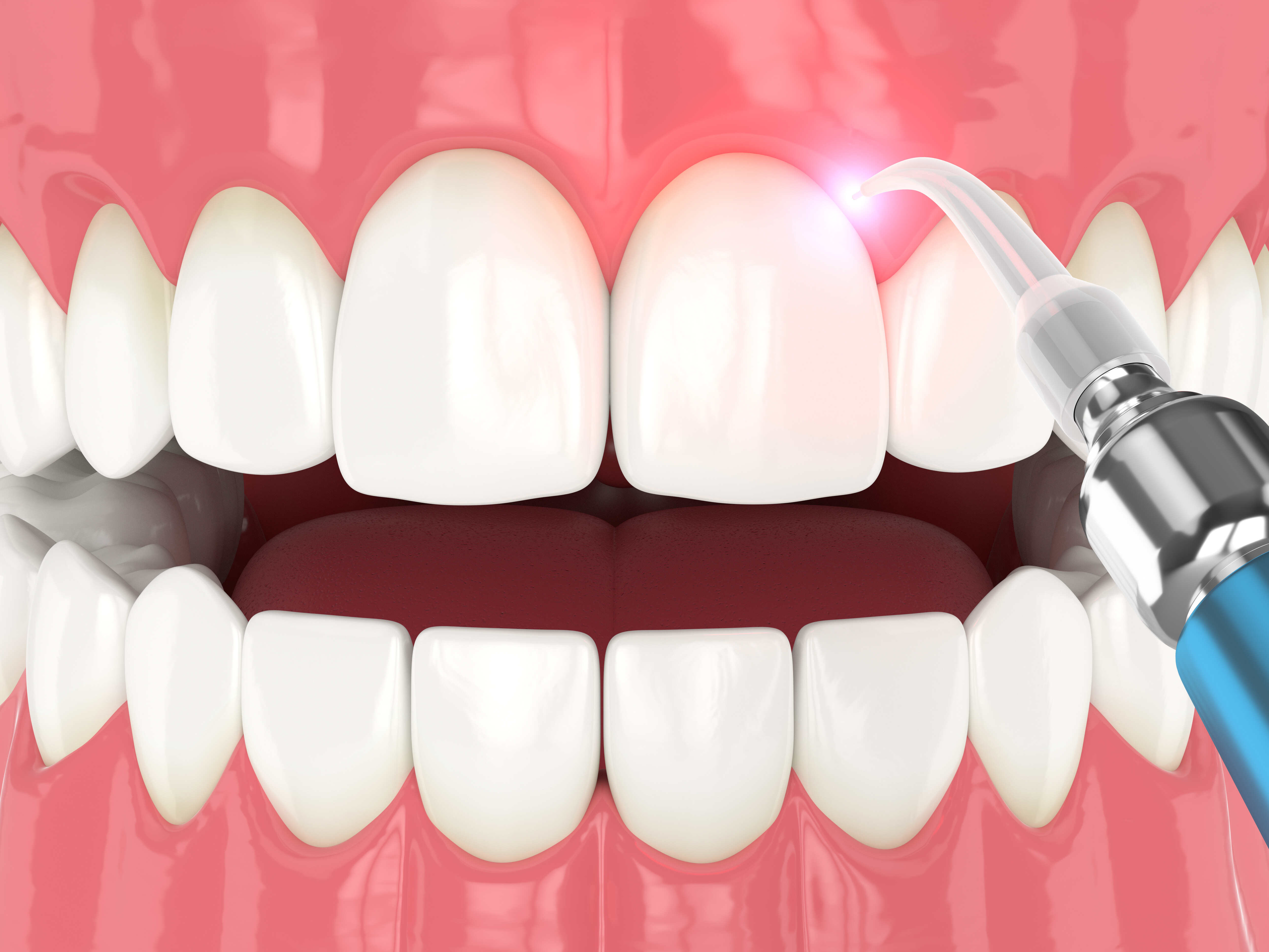 3d render of dental diode laser used to treat gums