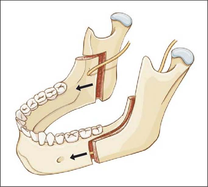 Bilateral Sagittal Split Osteotomy (BSSO)