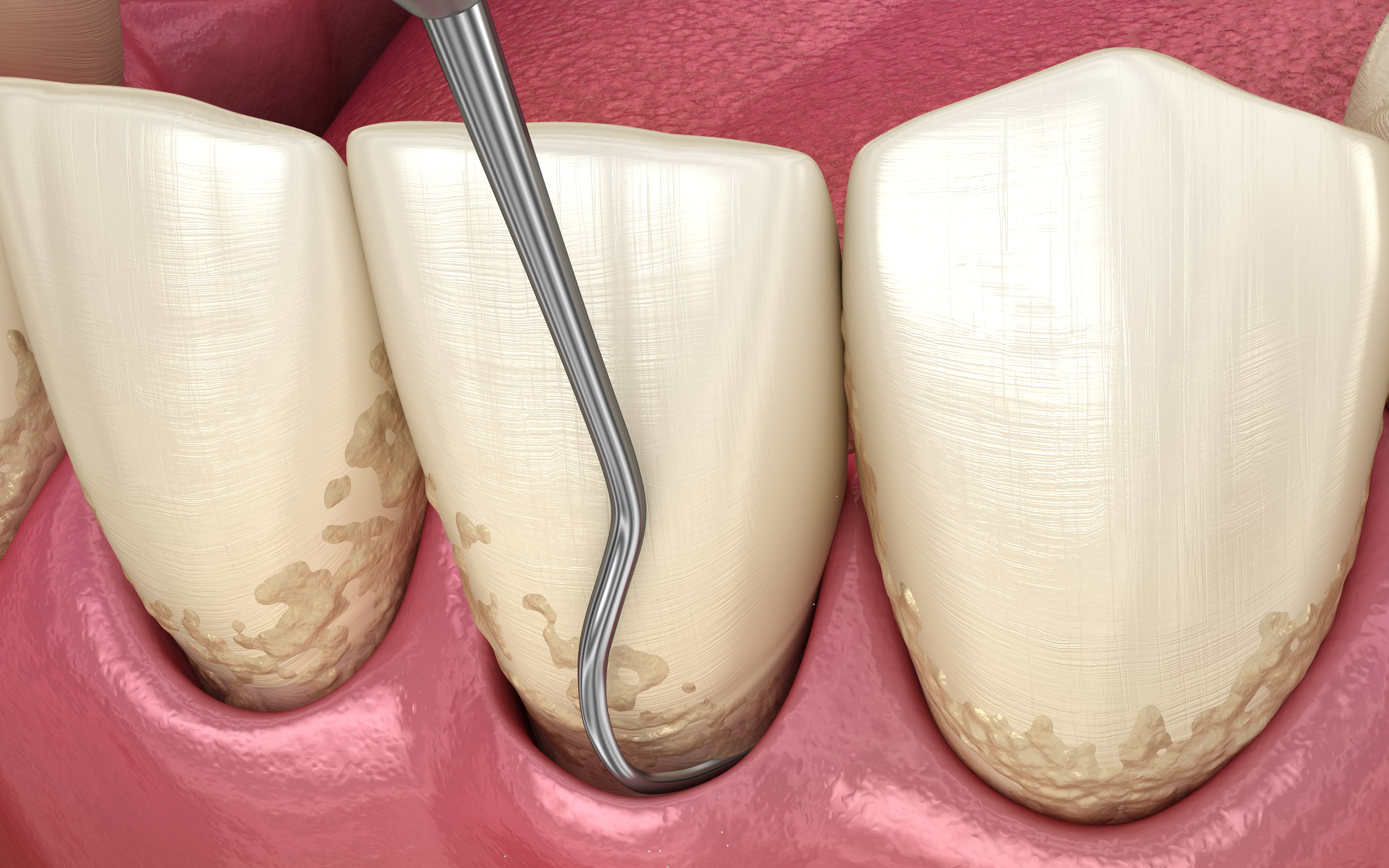 Closed curettage- Scaling and root planing (conventional periodontal therapy). Medically accurate 3D illustration of human teeth treatment