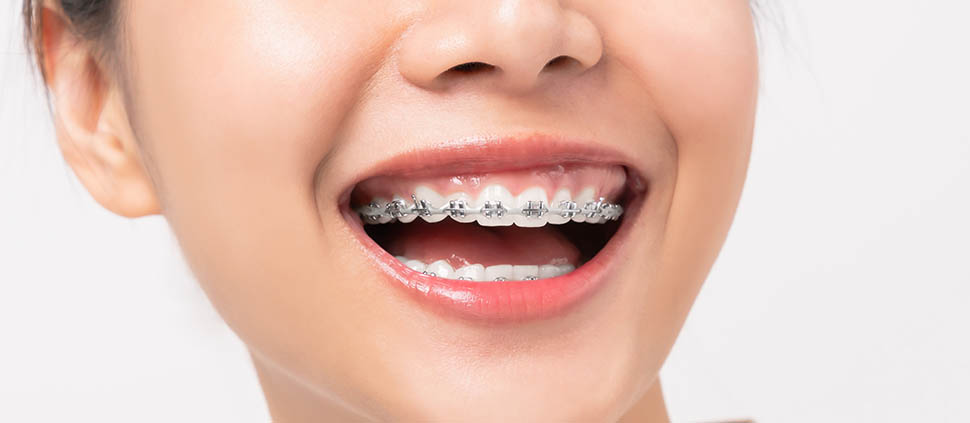 Damon Braces-1