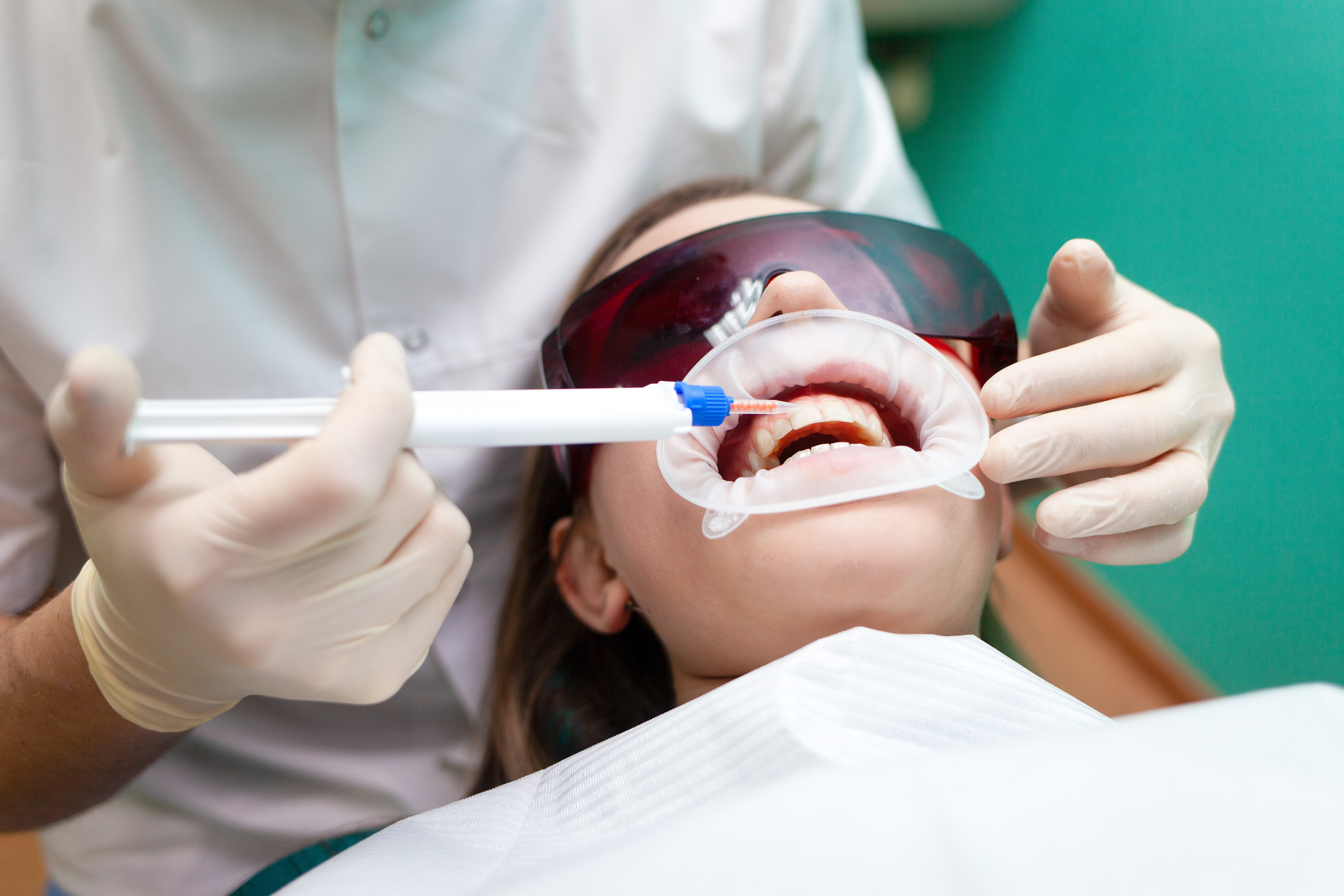 Dentist applies a tooth whitening gel with a syringe. Girl undergoes a teeth whitening procedure in a dental clinic
