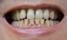 Discoloured Teeth