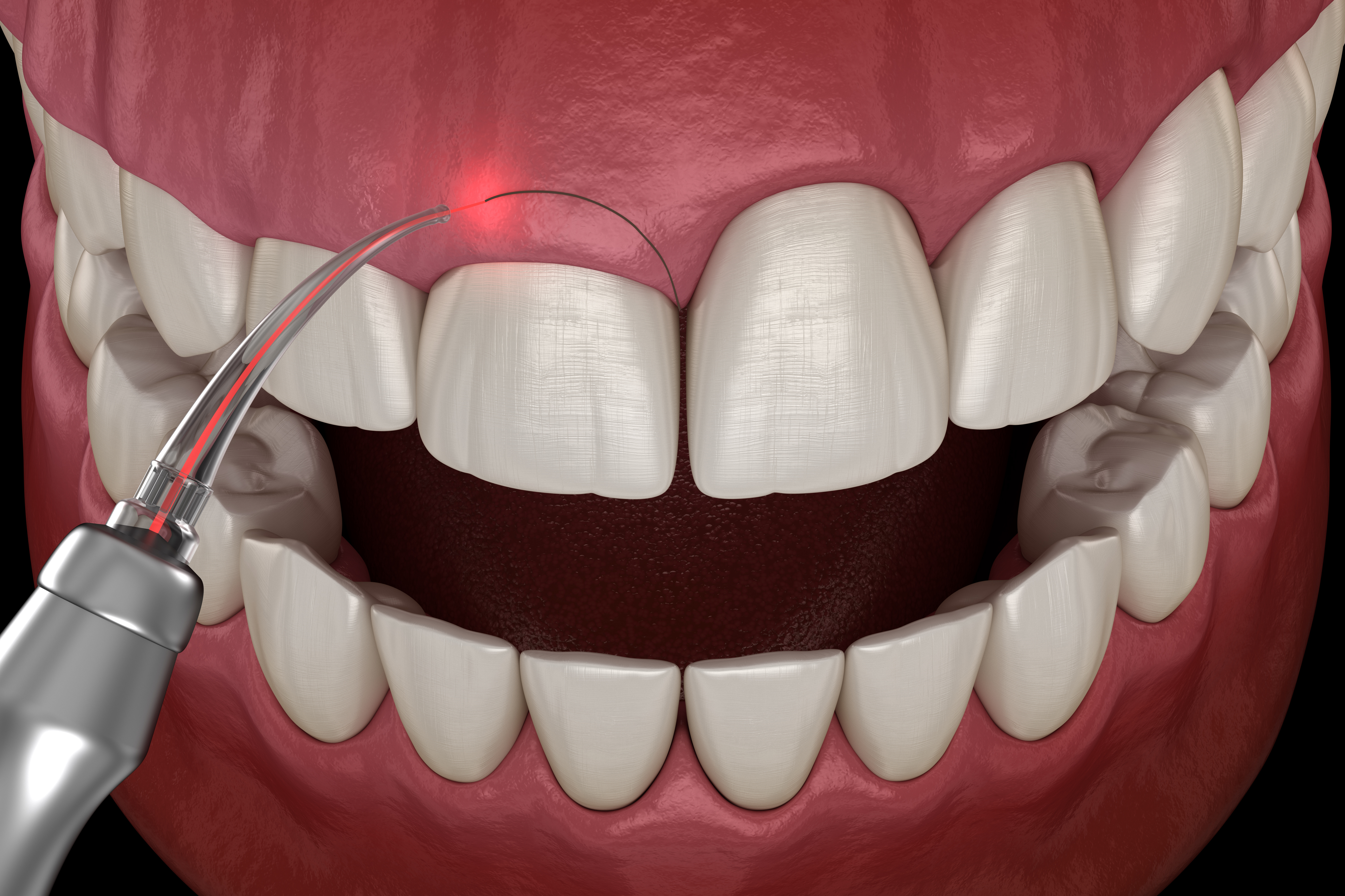 Gingivectomy surgery with laser using. Medically accurate tooth 3D illustration