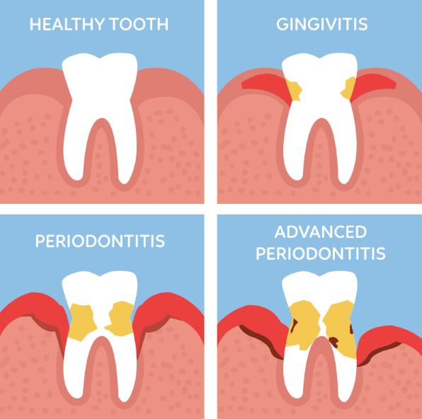Gum Disease Stages