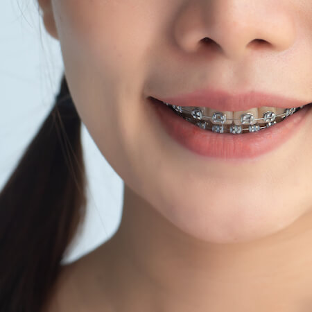 Kid braces