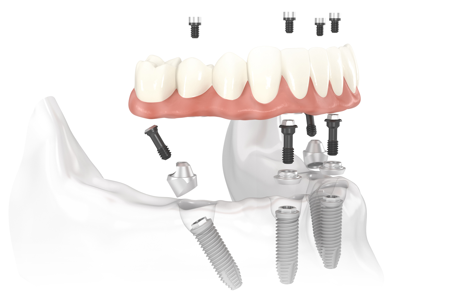 Nobel_Biocare_All-on-4_solution_image_1