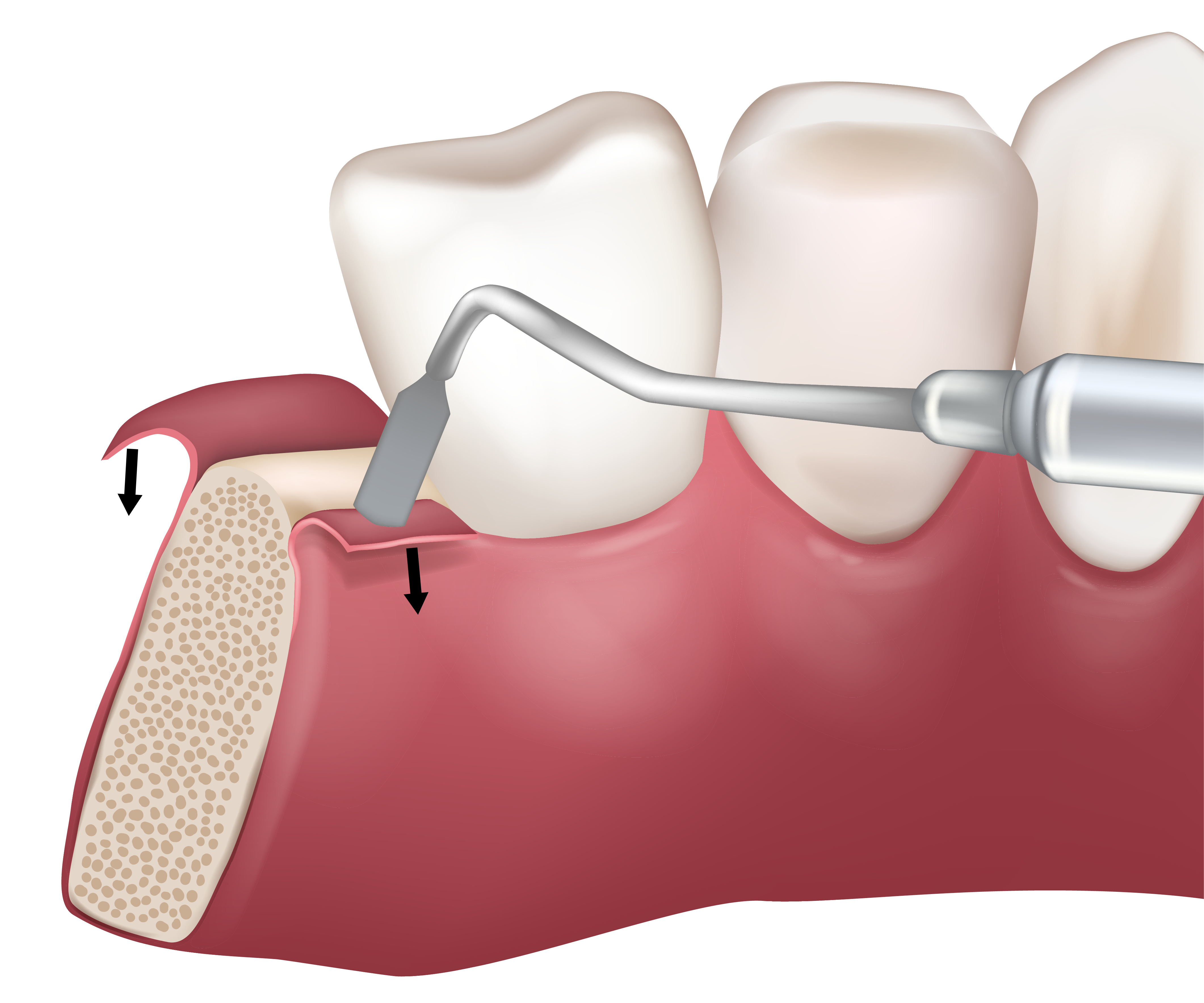 Mid-crestal incision used during implant bed preparation. Paracrestal Incision. Flap Techniques in Dentoalveolar Surgery. Periodontal surgery