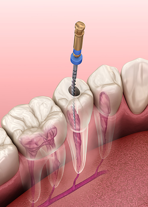 Root Canal Treatment1