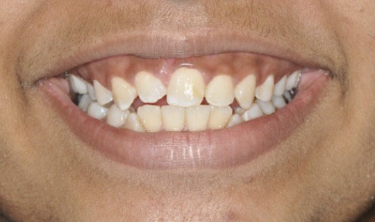 irregular-teeth