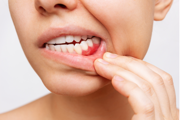What is Gum Disease