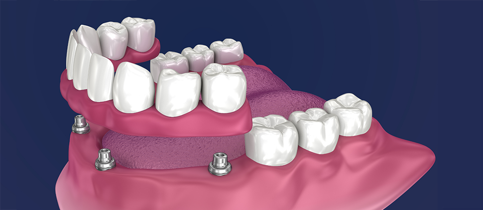 All-on-4 Dental Implants by Nuffield Dental