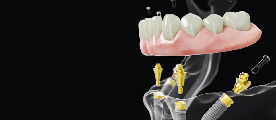 Examples of Patients who opted for All on 4: Teeth in a Day Implants