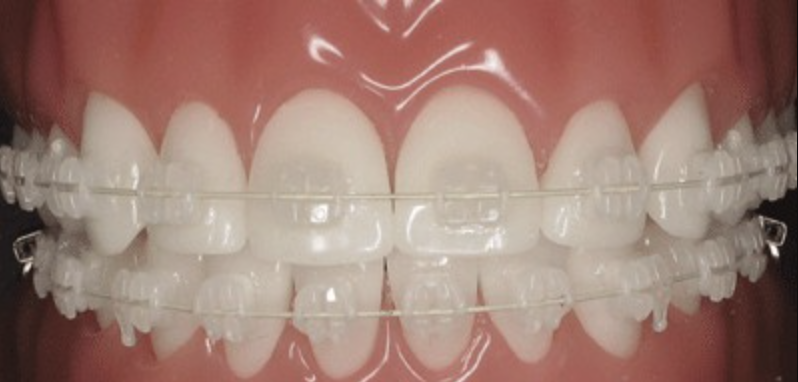 ceramic braces