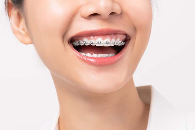 damon-braces-asian-girl-happy-smile-dental-care-oral-health