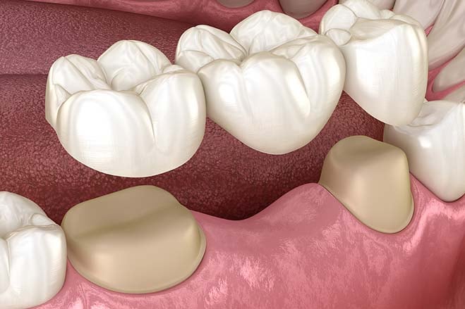 dental-bridges-smile-dental-care-oral-health