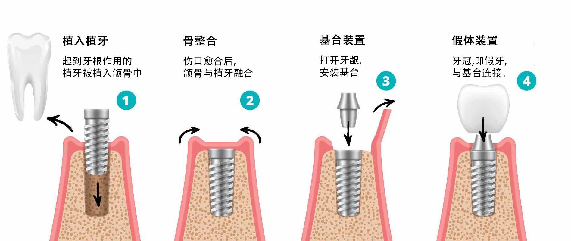dental-implants-graphic-02-1-ch
