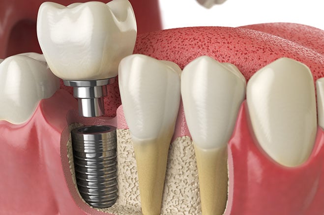 dental-implants