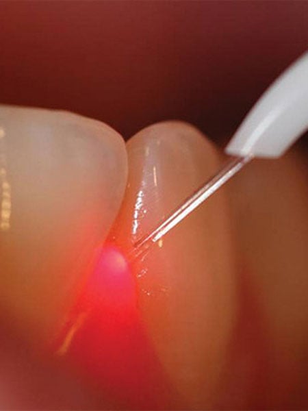 dental-lasers-digital-red-dental-care-technology