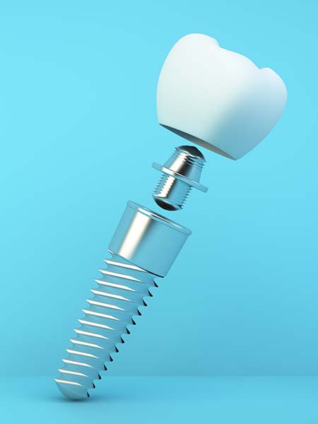 dental-prosthesis-dental-implant-dental-care-oral-health-blue